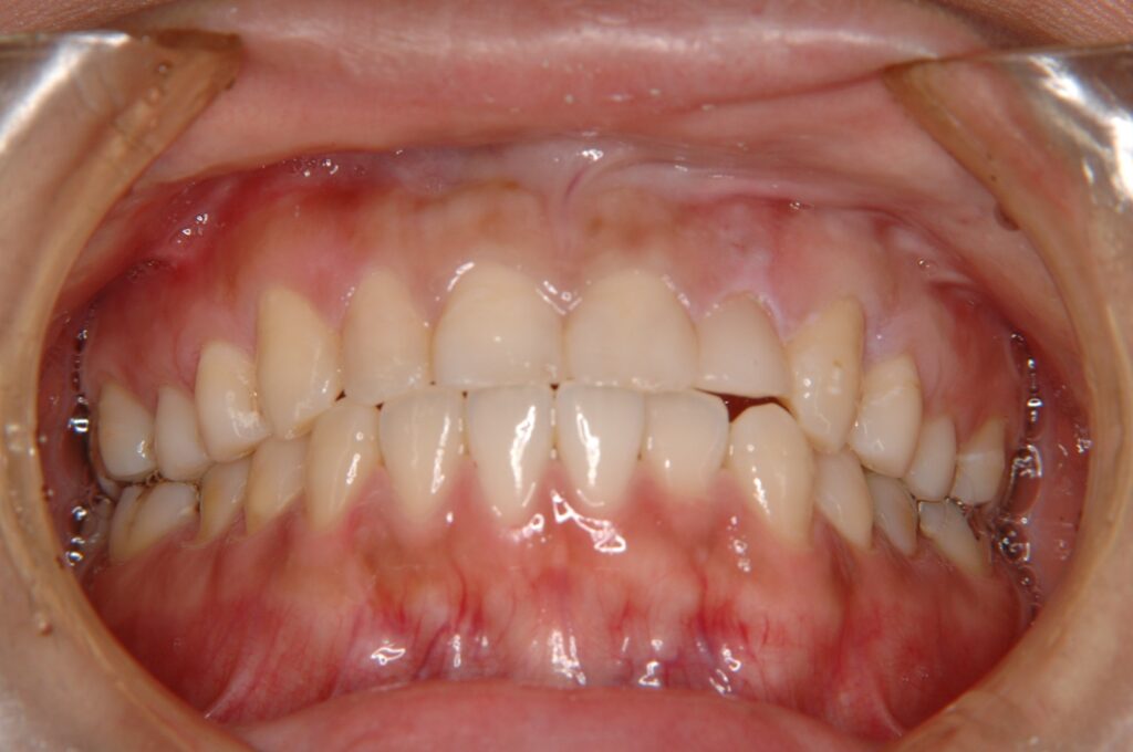 前歯治療