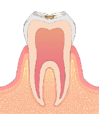 C1:初期のむし歯