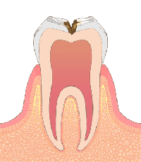 C2:むし歯の中期