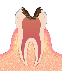 C3：むし歯の後期