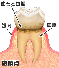歯と歯茎の間に、歯垢や歯石がたまり、歯茎が赤く腫れます。