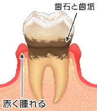 歯垢が硬い歯石となり、歯と歯茎の間の歯周ポケットと呼ばれる場所がどんどん深くなり、顎の骨にまで影響が出始めます。
